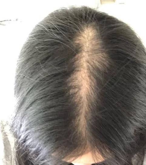 秃头女孩有救了 千万脱发患者推荐的生发妙招,后悔没早点知道