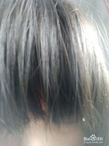脱发如何治疗