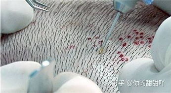 植发手术全过程,一定要看