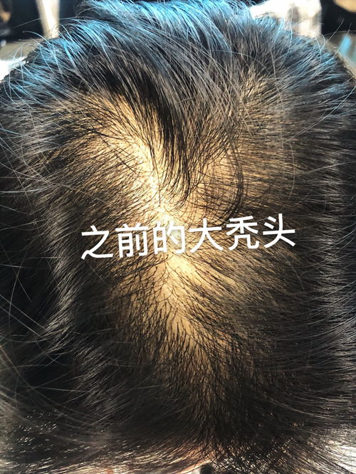 再也不是秃头了,脱发终于治好了