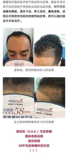 头发每天大把掉,遗传性脱发、秃顶…医生:治疗脱发千万别瞎用药