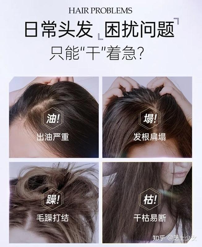 治疗脂溢性脱发的方法?