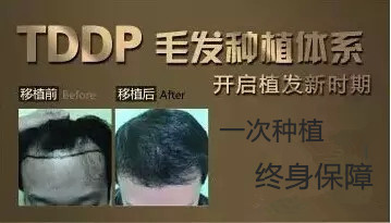 脱发 掉发:植发①次解决-