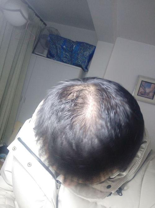 中肧层治疗脱发是否可靠