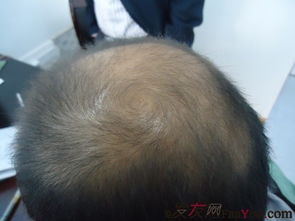 脱发类型