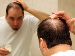 怎么防治男性脱发方法