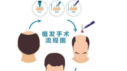 治疗脱发整形知识/小常识
