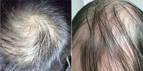 要聪明不要绝顶!讲一讲“脱发”的那些事