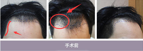 韩国moplus文珉善m型脱发治疗前术后照片