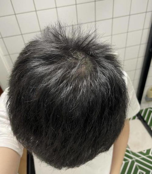 脱发严重怎么办 这个方法你绝对猜不到,专家都在用,赶快进来学