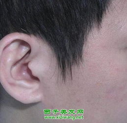 鬓角脱发是什么原因 鬓角脱发如何治疗