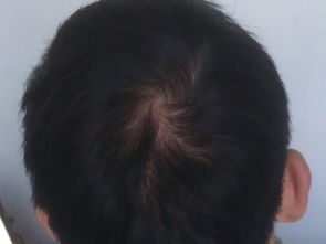 季节性脱发应该如何治疗比较好