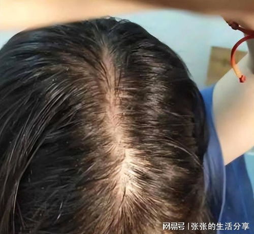 每天花费不到几元,轻松防脱育发,见证新发不断生长的奇迹