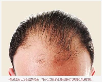 盘点男人脱发原因,对脱发的几大误区