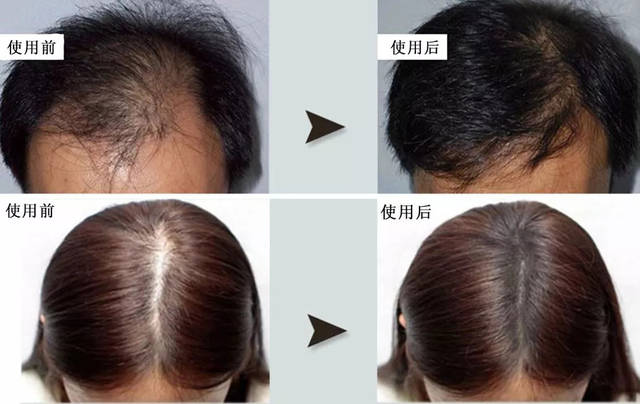饱受脱发困扰?一抹唤醒“瘫痪”毛囊,头发就这么长出来,拯救你消失的发际线!
