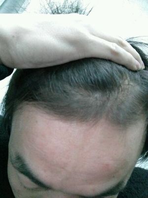 回复:如何治疗脱发和生发