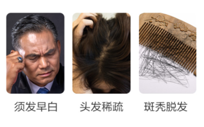 男性脱发能治好吗 注重这2点挽救脱发